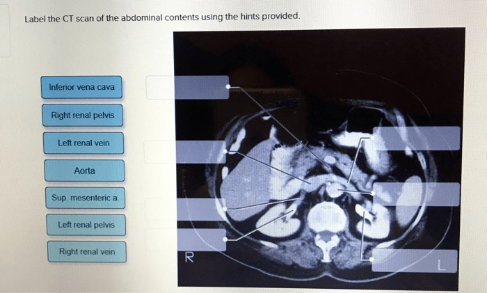 Abdominal structures posterior urinary label hints provided using